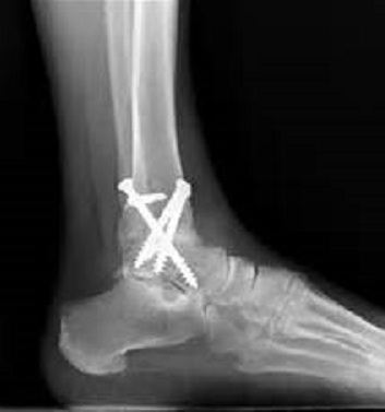 Zimmer Biometаl3DӡPںϵy@FDA